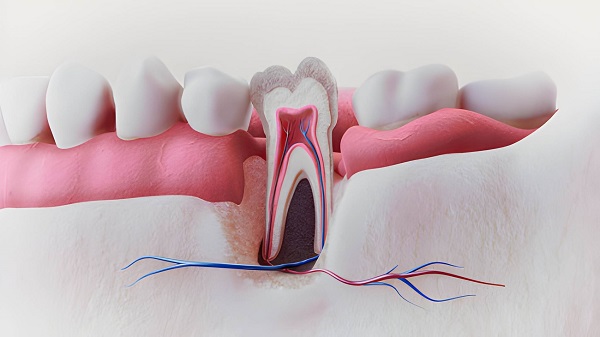 Best Root Canal Treatment in Bandra